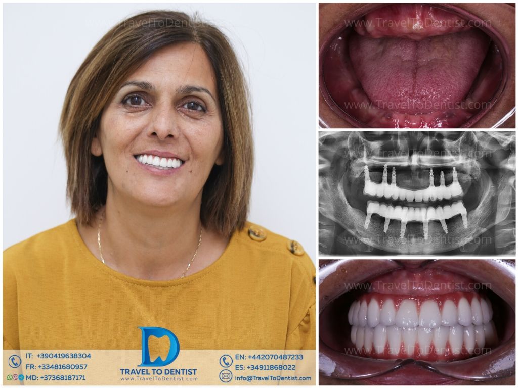Caso dental 5 - Resultado de tratamiento