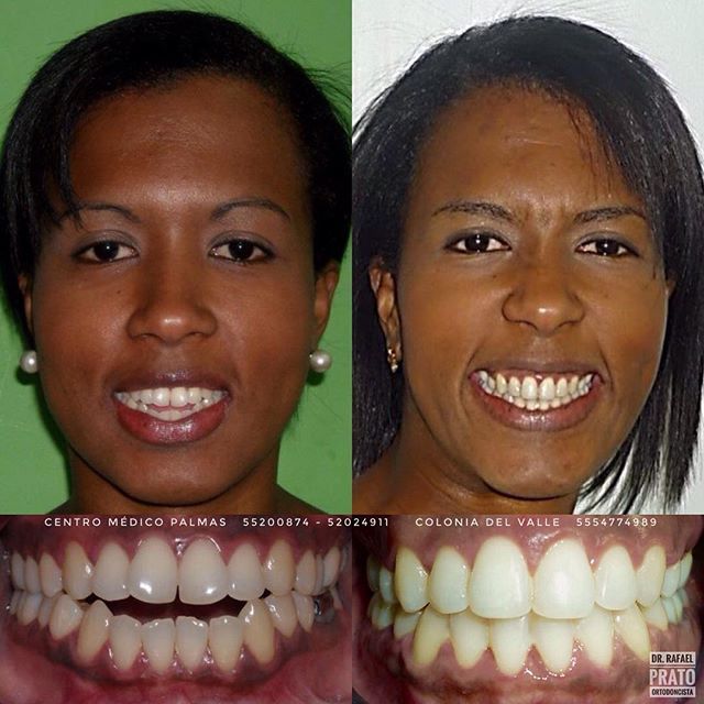 Caso dental 6 - Resultado de tratamiento