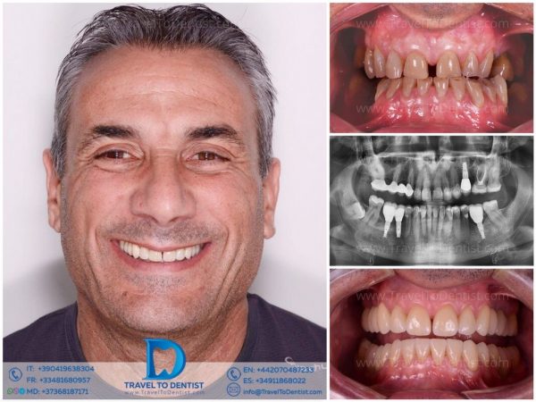Caso dental 2 - Resultado de tratamiento